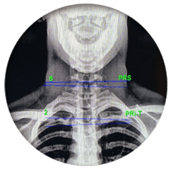 Chiropractic Burnsville MN X-Rays